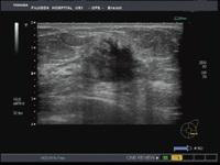 乳腺超音波の結果