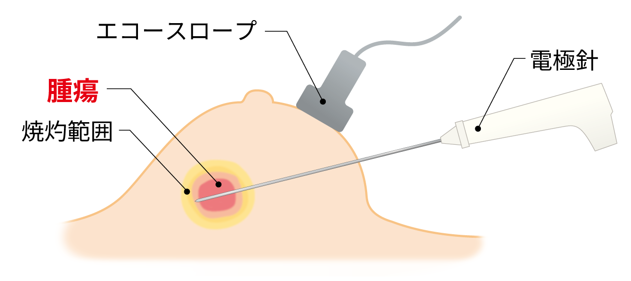 乳がんに対するラジオ波焼灼