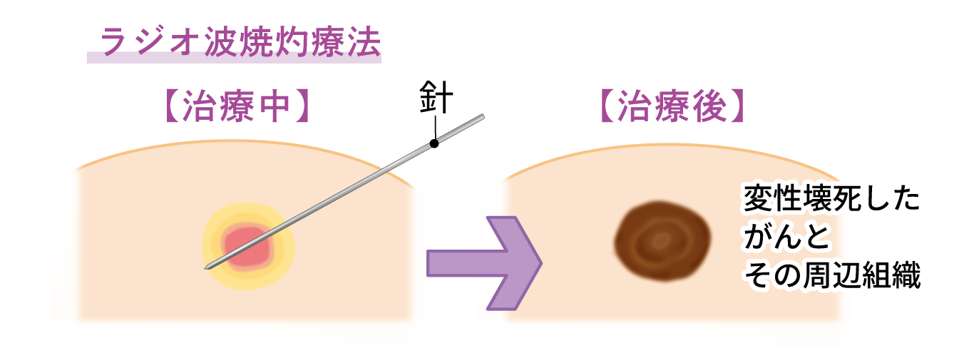 ラジオ波焼灼療法のシェーマ
