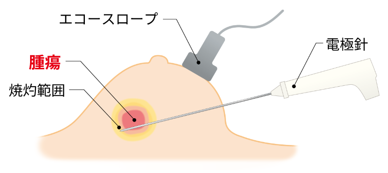 ラジオ波イラスト