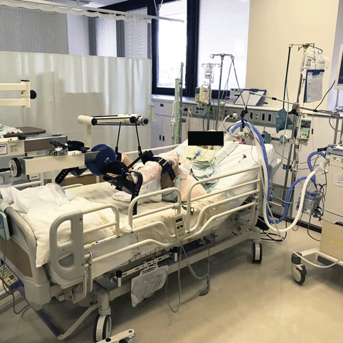 人工呼吸器管理中の患者に対するパッシブサイクリング