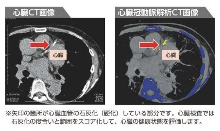 心臓CT画像と心臓冠動脈解析CT画像