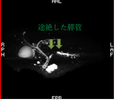 MRCP検査