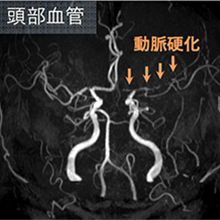 頭部血管の動脈硬化