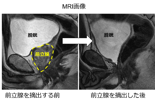前立腺がんを摘出する前と後